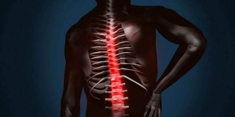 Wirbelsäulenverletzungen aufgrund von Osteochondrose.